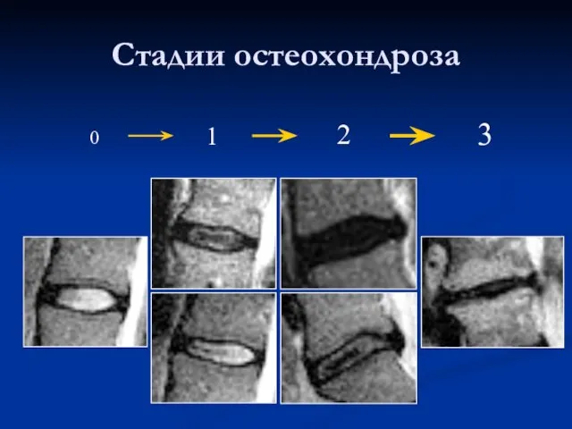 Стадии остеохондроза 0 1 2 3