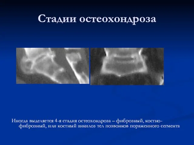 Стадии остеохондроза Иногда выделяется 4-я стадия остеохондроза – фиброзный, костно-фиброзный, или костный