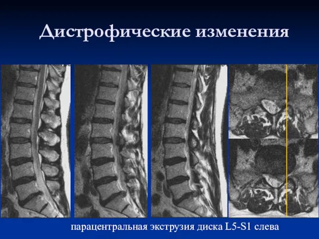 Дистрофические изменения парацентральная экструзия диска L5-S1 слева