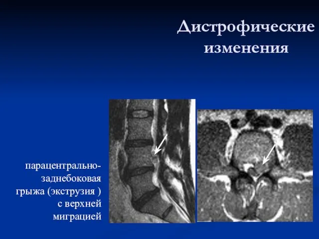 Дистрофические изменения парацентрально-заднебоковая грыжа (экструзия ) с верхней миграцией