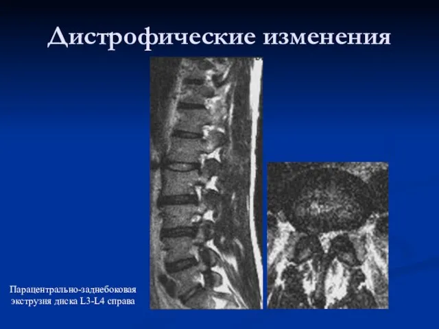 Дистрофические изменения Парацентрально-заднебоковая экструзия диска L3-L4 справа