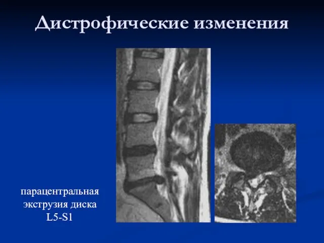 Дистрофические изменения парацентральная экструзия диска L5-S1