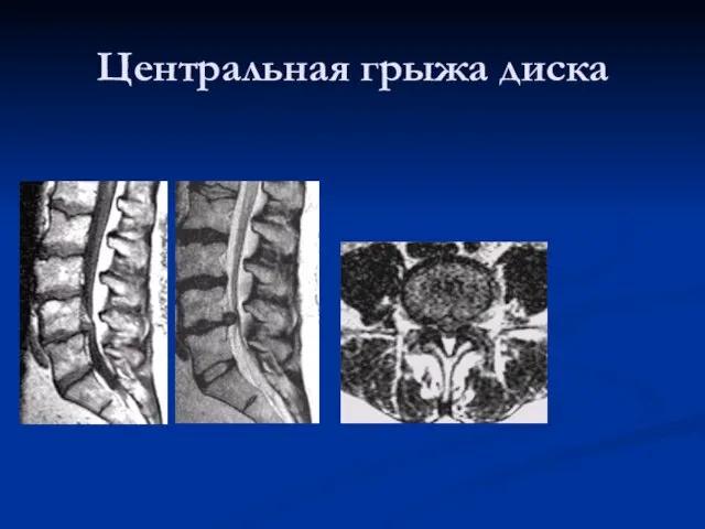 Центральная грыжа диска