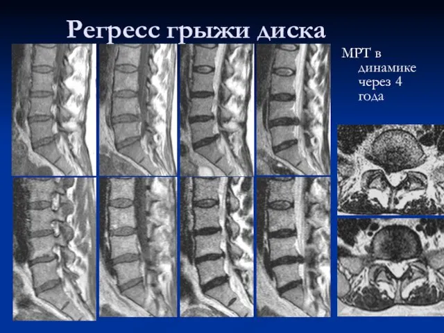 Регресс грыжи диска МРТ в динамике через 4 года