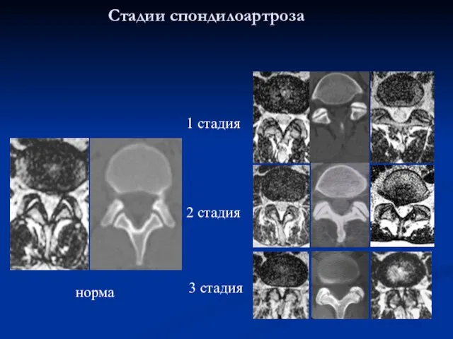 Стадии спондилоартроза 2 стадия 3 стадия норма 1 стадия