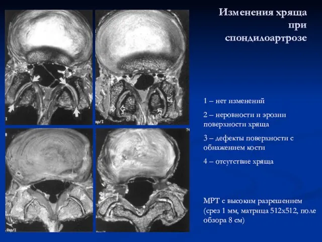 Изменения хряща при спондилоартрозе МРТ с высоким разрешением (срез 1 мм, матрица