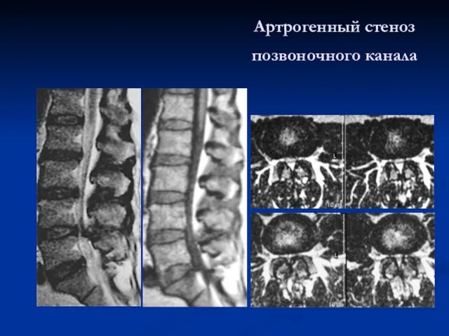 Артрогенный стеноз позвоночного канала