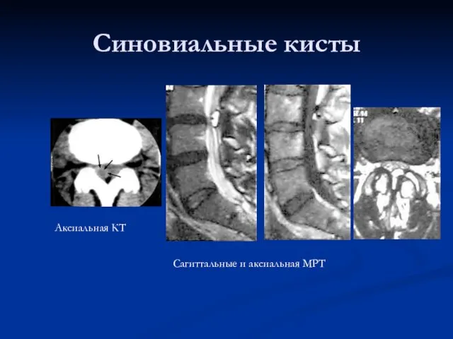 Синовиальные кисты Аксиальная КТ Сагиттальные и аксиальная МРТ