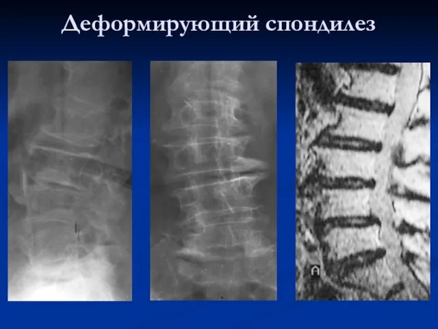 Деформирующий спондилез