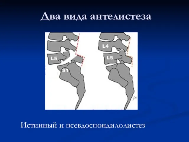 Два вида антелистеза Истинный и псевдоспондилолистез