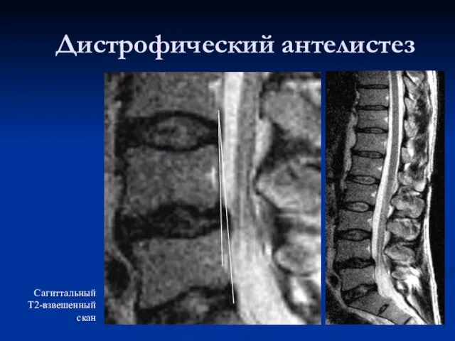 Дистрофический антелистез Сагиттальный Т2-взвешенный скан