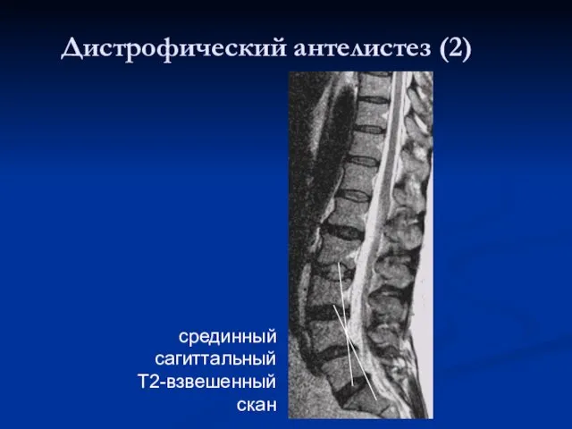 Дистрофический антелистез (2) срединный сагиттальный Т2-взвешенный скан