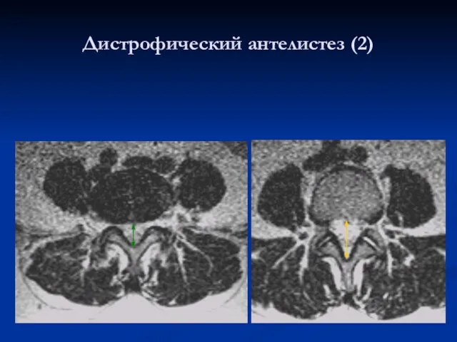 Дистрофический антелистез (2)