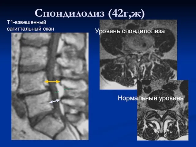 Спондилолиз (42г,ж) Уровень спондилолиза Нормальный уровень Т1-взвешенный сагиттальный скан