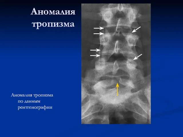 Аномалия тропизма Аномалия тропизма по данным рентгенографии