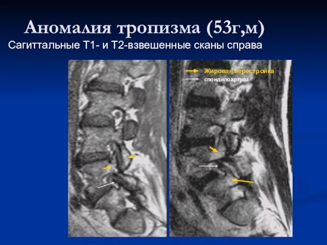 Аномалия тропизма (53г,м) Сагиттальные Т1- и Т2-взвешенные сканы справа Жировая перестройка спондилоартроз