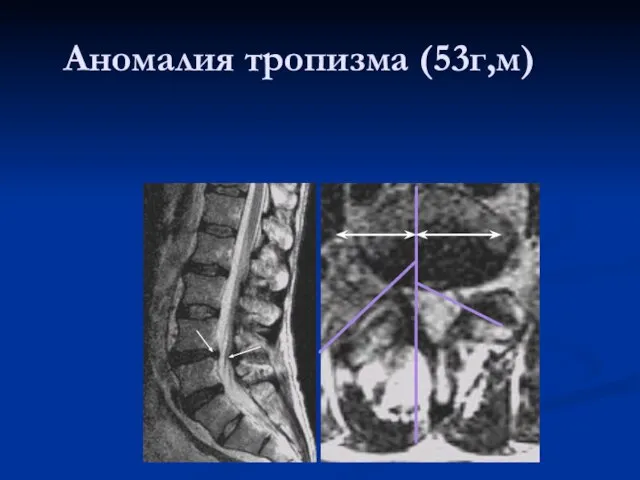 Аномалия тропизма (53г,м)