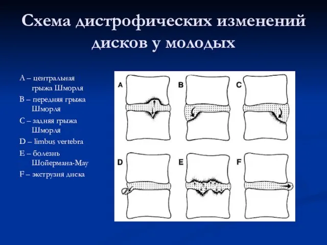 Схема дистрофических изменений дисков у молодых А – центральная грыжа Шморля B