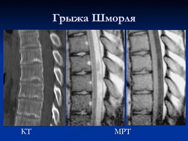 Грыжа Шморля МРТ КТ