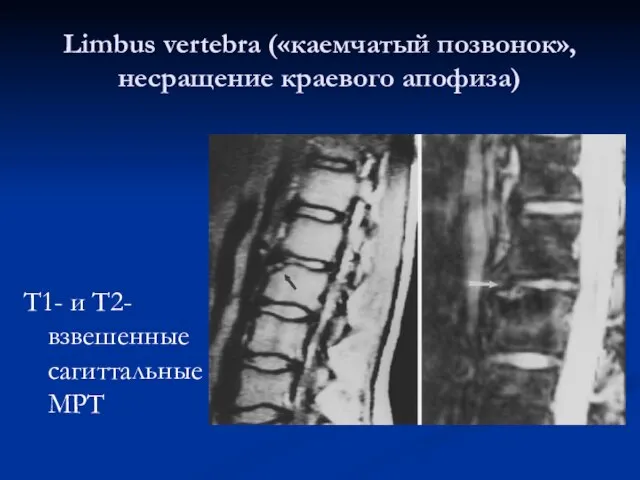 Limbus vertebra («каемчатый позвонок», несращение краевого апофиза) T1- и Т2- взвешенные сагиттальные МРТ