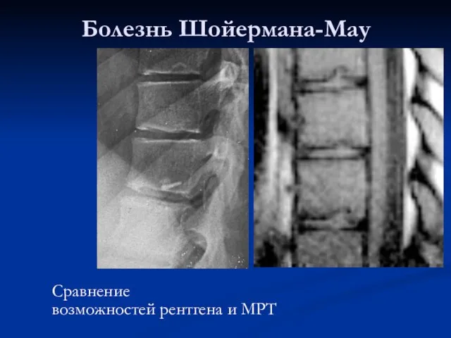 Болезнь Шойермана-Мау Сравнение возможностей рентгена и МРТ