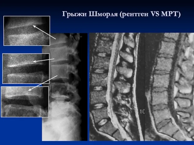 Грыжи Шморля (рентген VS МРТ)