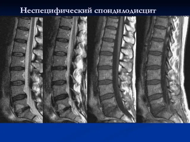 Неспецифический спондилодисцит