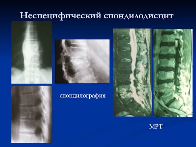 Неспецифический спондилодисцит спондилография МРТ