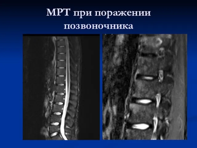 МРТ при поражении позвоночника