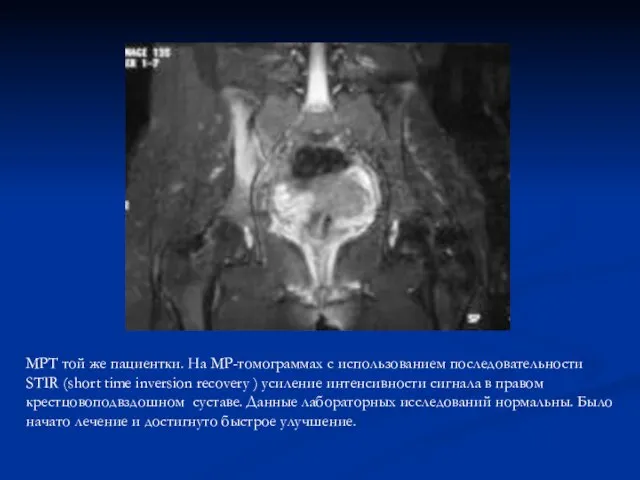МРТ той же пациентки. На МР-томограммах с использованием последовательности STIR (short time