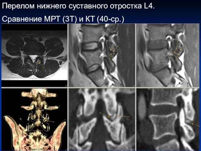 Перелом нижнего суставного отростка L4. Сравнение МРТ (3T) и КТ (40-ср.)