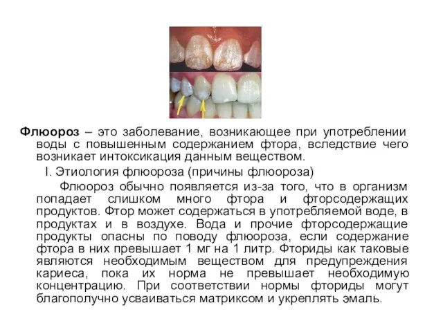 Флюороз – это заболевание, возникающее при употреблении воды с повышенным содержанием фтора,