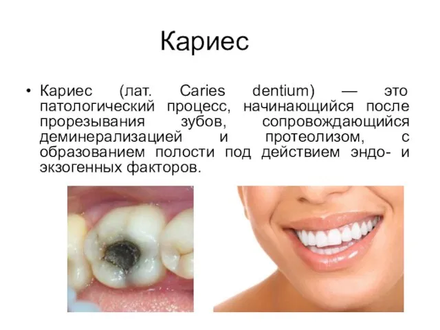 Кариес Кариес (лат. Caries dentium) — это патологический процесс, начинающийся после прорезывания