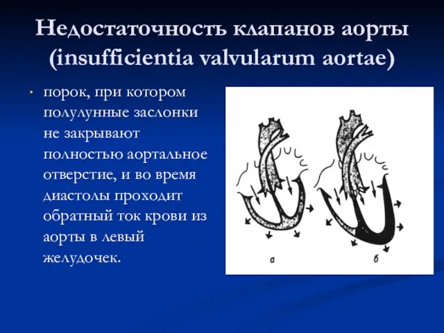 Недостаточность клапанов аорты (insufficientia valvularum аortae) порок, при котором полулунные заслонки не