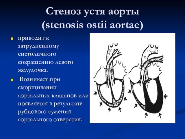 Стеноз устя аорты (stenosis ostii aortae) приводит к затрудненному систоличного сокращению левого