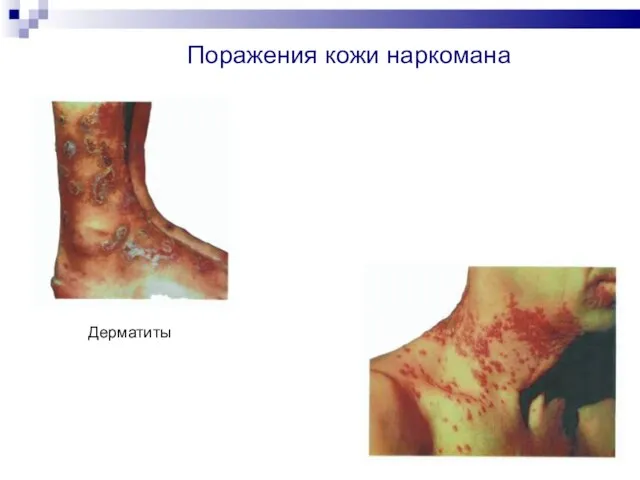 Дерматиты Поражения кожи наркомана