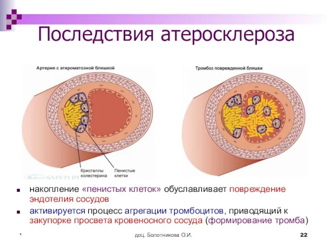 доц. Болотникова О.И. * Последствия атеросклероза накопление «пенистых клеток» обуславливает повреждение эндотелия