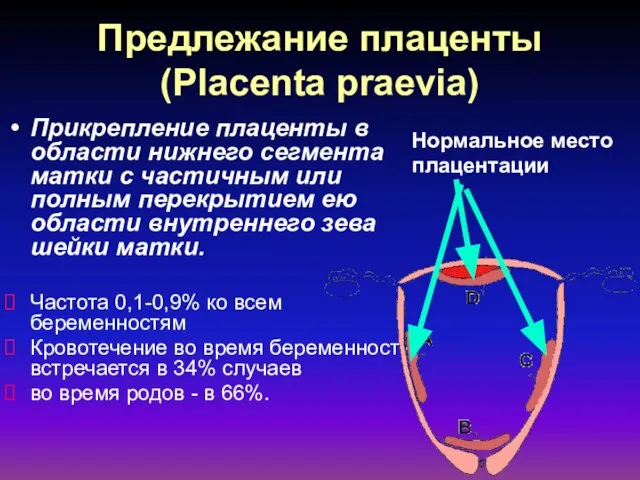 Предлежание плаценты (Placenta praevia) Прикрепление плаценты в области нижнего сегмента матки с