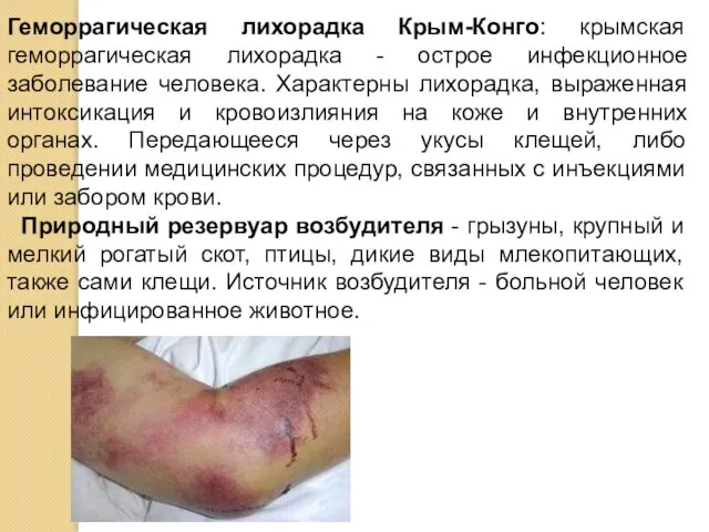 Геморрагическая лихорадка Крым-Конго: крымская геморрагическая лихорадка - острое инфекционное заболевание человека. Характерны