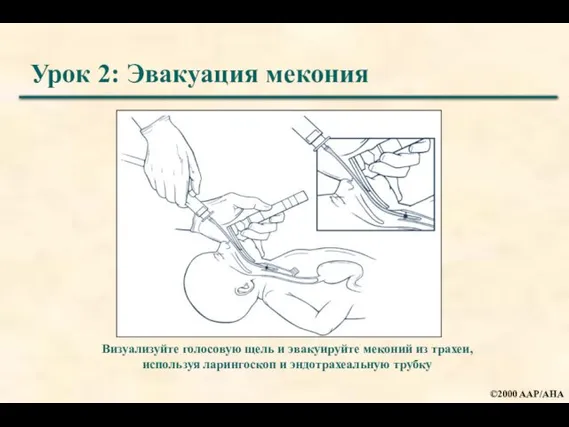 Урок 2: Эвакуация мекония Визуализуйте голосовую щель и эвакуируйте меконий из трахеи,