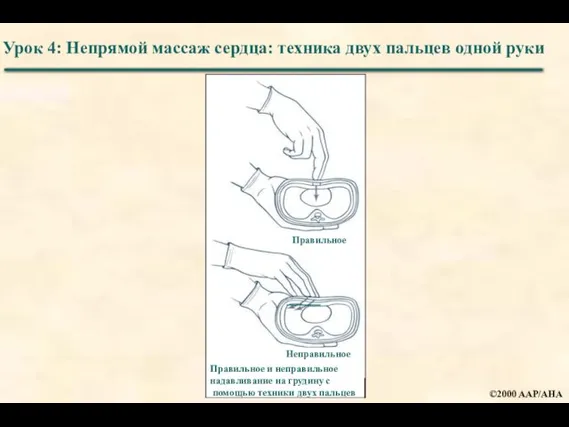 Урок 4: Непрямой массаж сердца: техника двух пальцев одной руки ©2000 AAP/AHA