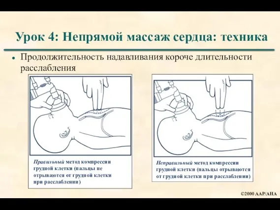 Урок 4: Непрямой массаж сердца: техника Продолжительность надавливания короче длительности расслабления Правильный