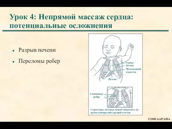 Урок 4: Непрямой массаж сердца: потенциальные осложнения Разрыв печени Переломы ребер Печень