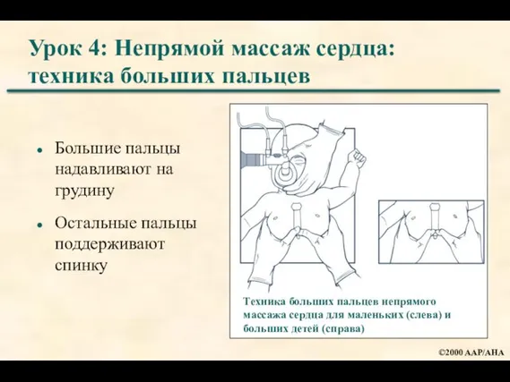 Урок 4: Непрямой массаж сердца: техника больших пальцев Большие пальцы надавливают на