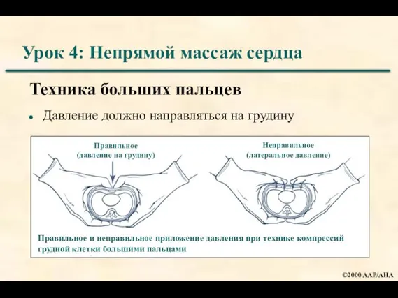 Урок 4: Непрямой массаж сердца Техника больших пальцев Давление должно направляться на