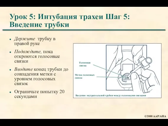 Урок 5: Интубация трахеи Шаг 5: Введение трубки Держите трубку в правой