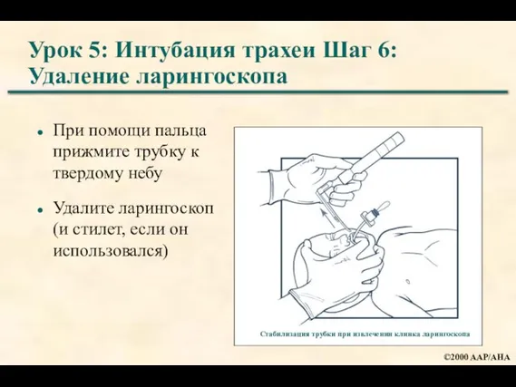 Урок 5: Интубация трахеи Шаг 6: Удаление ларингоскопа При помощи пальца прижмите