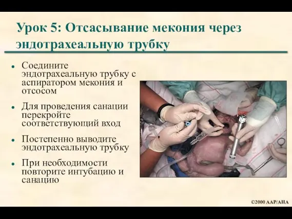 Урок 5: Отсасывание мекония через эндотрахеальную трубку Соедините эндотрахеальную трубку с аспиратором