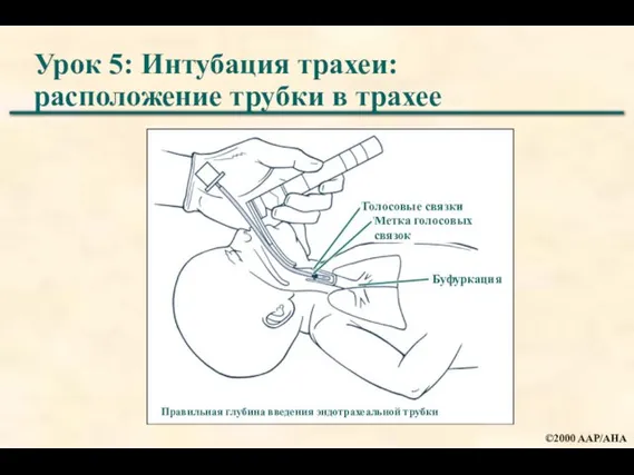 Урок 5: Интубация трахеи: расположение трубки в трахее Правильная глубина введения эндотрахеальной