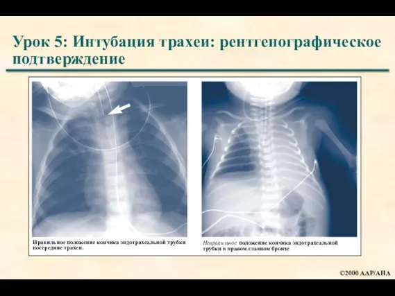 Урок 5: Интубация трахеи: рентгенографическое подтверждение Правильное положение кончика эндотрахеальной трубки посередине